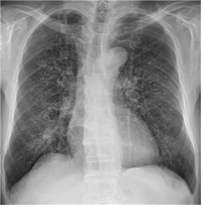 폐증 환자의 X-ray 검사 사진. 폐에 분진이 침착하여 폐 세포에 염증과 섬유화가 일어난 상태로, 갈비뼈 사이로 하얗게 점처럼 보이는 진폐성 음영을 관찰할 수 있다. [사진=서울성모병원]