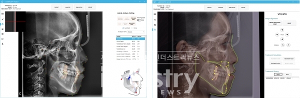 AI를 활용한 자동 계측화면(좌)과 VTO_STO화면(우) [사진=라온피플]