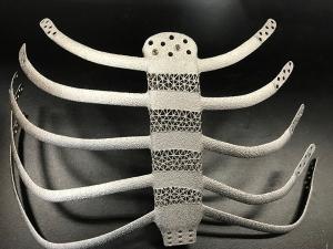 생기원, 금속 3D프린팅 난점 해결하고 세계 최대 규모 인공 흉곽 제작